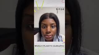 Surgery recovery - ethnic nose job, facial contouring surgery