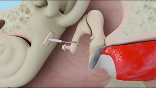 Stapedotomy Animation to Treat Otosclerosis (Curable Type of Hearing Loss)