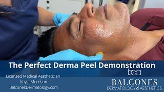 The Perfect Derma Peel Demo | Balcones Dermatology & Aesthetics |Austin, TX | Ph:512-459-4869