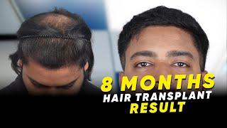 Hair Transplant in Bangalore | Best Results & Cost of Hair Transplant in Bangalore