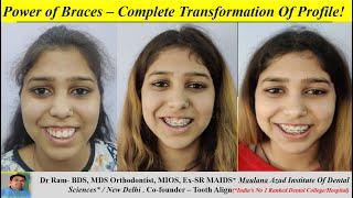 Braces Journey. Severe Gummy Smile &  Forward  Teeth. Fixed Orthodontic Treatment. Dr Ram MDS, Delhi