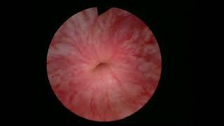 Core Videos (2021): Step-by-Step Placement of the Artifical Urinary Sphincter