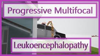 Progressive Multifocal Leukoencephalopathy (Mnemonic for the USMLE)
