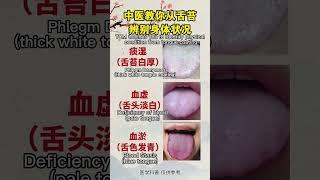 中医教你从舌苔辨别身体情况