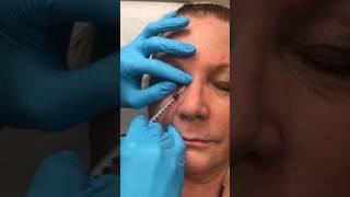 Dermatologist, Dr Hsu Performs Dysport Injection