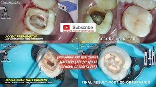 ONE VISIT ENDO & INTERMEDIATE RESTORATION IN 2ND VISIT - REMOVAL OF BROKEN FILE + 3D OBTURATION ️