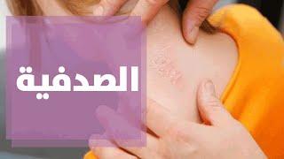 الصدفية: ما هو علاجها؟ وما أعراضها؟