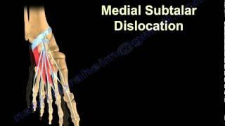 Dislocations Of The Talus - Everything You Need To Know - Dr. Nabil Ebraheim