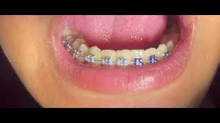 Multiple colorful ligaties(braces adjustment)