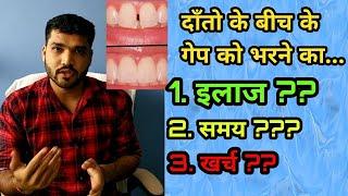 दाँतो के बीच के गेप भरने का इलाज और खर्च | Treatment of gap of two teeth in hindi (English Subtitle)