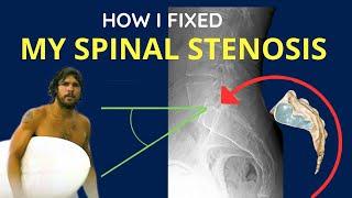 How I Reversed Spinal Stenosis without Surgery