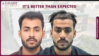 Restore Your Confidence: Best Hair Transplant Results in India!