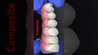 Full Composite on titanium bar #bestdentist #dentist #dentalwork #dental #smile #dentaldesign