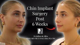 Inside a chin implant surgery - Dr. Julian De Silva