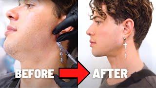 How to Define your Jawline without Surgery! (Before and After)