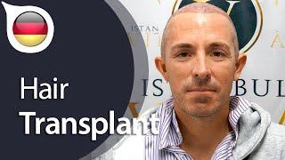 My Experience with Istanbul Vita from Germany | Hair Transplant in Istanbul / Turkey