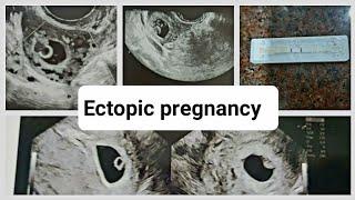 सोनोग्राफी में pregnancy  uterus (बच्चेदानी) में दिखाई नहीं दे रही। Ectopic pregnancy तो नहीं है ?