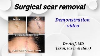 Surgical scar removal @DrArifMDDermatologist #scarsurgery #scartreatment #scar