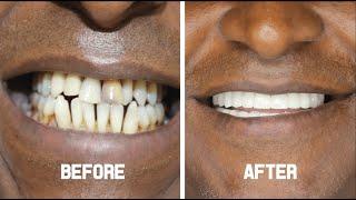 Zirconium Crowns (Hollywood Smile) - Hassan From England