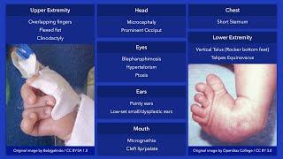 Trisomy 18 (Edward Syndrome): Dysmorphic Features