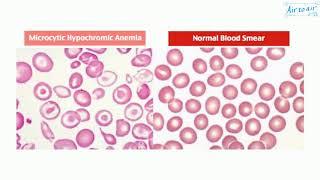 microcytic hypochromic anemia