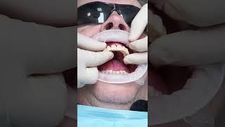 Dental implant’s All on 4 in Prague #shorts #dentist #dental #implant #veneers #short