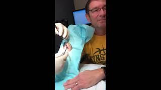 Lipoma Removal