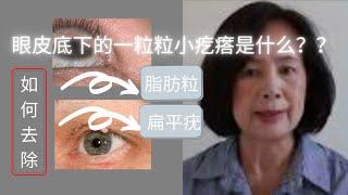 wart solution around eyelid | tip n trick to remove wart | 如何去掉上眼皮的疣 |  眼周护理小百科 | 去疣/脂肪粒经验分享 。