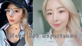 My Nose Job Experience 1yr + Recovery | Part 1| Asian Rhinoplasty｜鼻综合术后经历 