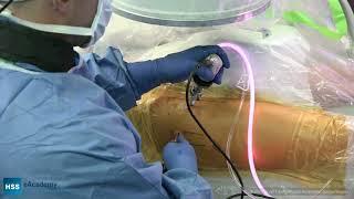 Arthroscopic Femoral Acetabular Impingement Surgery: Part 2 Interportal Cut (Parallel to Labrum)