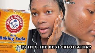 I used BAKING SODA on my face for 2 WEEKS and this happened… | baking soda on the face  #bakingsoda