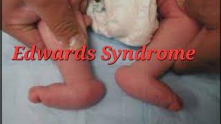 Edwards Syndrome|Trisomy 18|By Dr.Hemangi