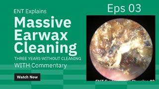 Satisfying Earwax Cleaning #3- Cholesteatoma with Commentary