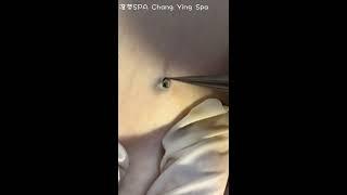 Deep DPOW extraction - Dilated Pore of Winer extraction - ChangYing Spa