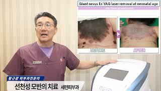 선천성 멜라닌 세포 모반 치료 수술의 모든 것:Everything, Treatment of Congenital Melanocytic Nevus, Serion Dermatology