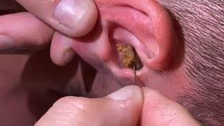耳掃除の難聴 最大の耳垢除去 | #T7H