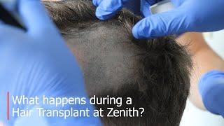 What happens during a Hair Transplant at Zenith?