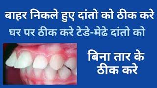 बाहर निकले हुए दांतो को ठीक करे//घरेलू उपाय टेडे मेढे दांतो को ठीक करे// orthodontic treatment