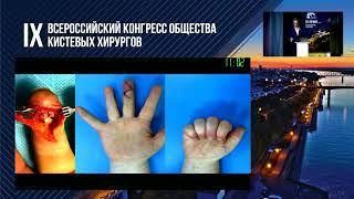 Назарян Г.А.: отрывные переломы дистальной фаланги.