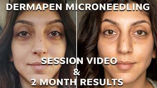 Dermapen Microneedling Before And After [UPDATE] | Amazing 2 Month Results!!!