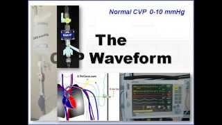 CVP and Arterial Line Waveform Interpretation