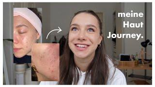My Skincare Journey l getting rid of acne l Sophie Helene