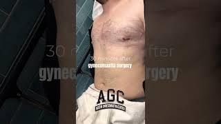 Gynecomastia Before & After with Dr Caridi of Austin Gynecomastia Center #menshealth #chestworkout