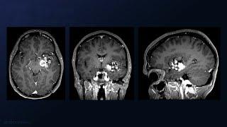 Transsylvian-Transinsular Resection of a Giant Putaminal Basal Ganglia Cavernous Malformation