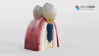 Megagen Anyridge Dental Implant