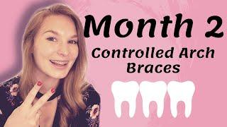 Month 2 Braces Update | Controlled Arch Braces