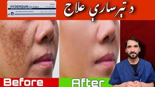 Melasma Treatment By Dr Adnan Khan