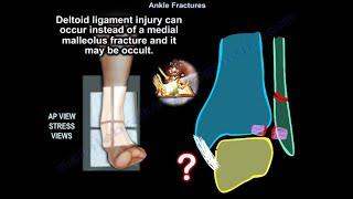 Ankle Fractures - Everything You Need To Know - Dr. Nabil Ebraheim