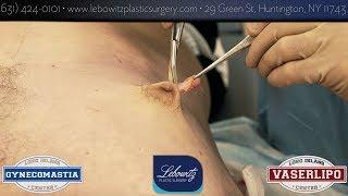 Vaser Lipo Gynecomastia Hi-Def Results At The Gynecomastia Center Long Island Huntington NY