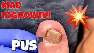 MAD INGROWN TOENAIL REMOVAL